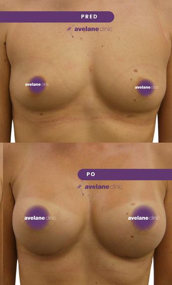 Zlepšenie tvaru a objemu