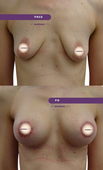 Zlepšenie tvaru a symetrie