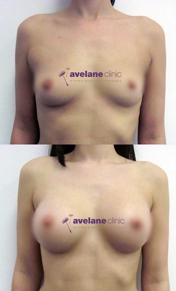 Estetická úprava po strate objemu