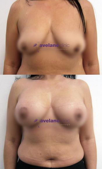 Výsledky plastickej chirurgie