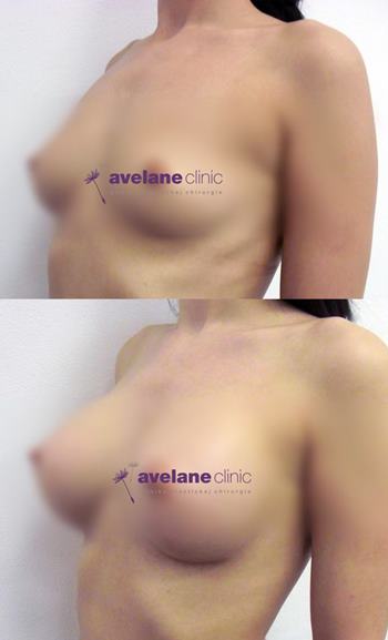 Jemná úprava tvaru