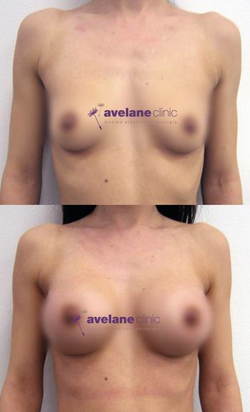 Zvýšenie objemu a pevnosti