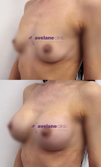 Úprave pŕs implantátmi