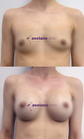 Zdokonalenie kontúr a proporcií