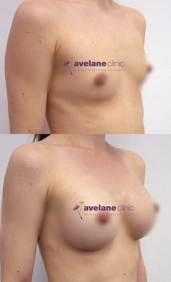 Prirodzený vzhľad po zákroku