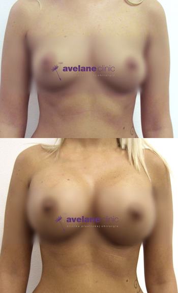 Plnší a prirodzený dekolt