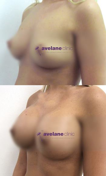 Úprave pŕs s implantátmi – výsledok