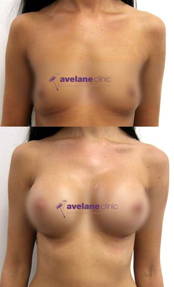 Úprava pŕs implantátmi – estetická úprava