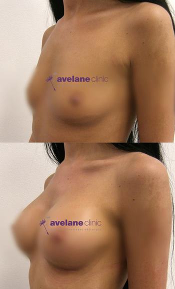 Zlepšenie tvaru a symetrie