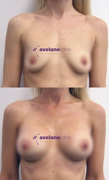 Jemná úprava s prirodzeným efektom