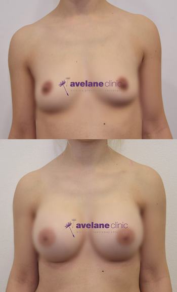 Prirodzený tvar po zákroku