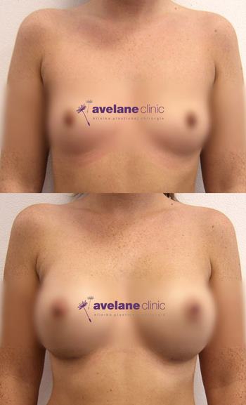 Tvarovanie pre mladistvý vzhľad