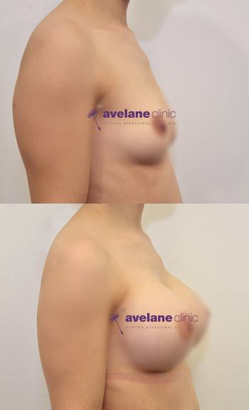 Symetrický a prirodzený výsledok