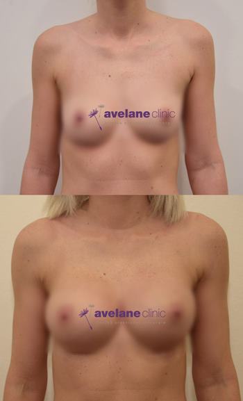 Výsledok s prirodzeným efektom