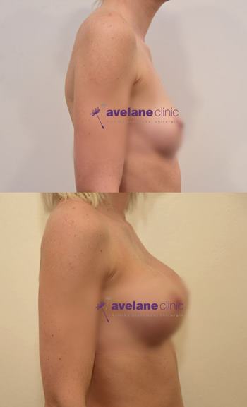 Výsledok estetickej operácie