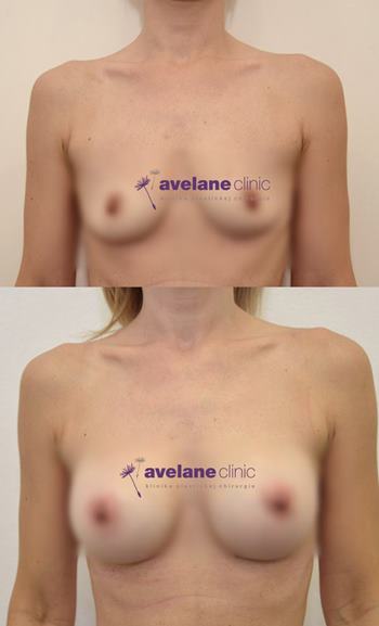 Zlepšenie tvaru a symetrie