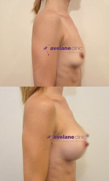 Výsledok s prirodzeným efektom