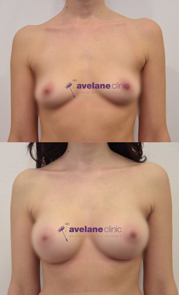 Úprava pŕs implantátmi – jemná úprava tvaru