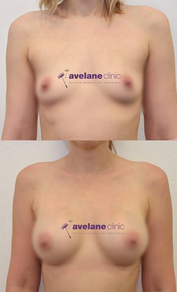 Korekcia asymetrie na Avelane clinic