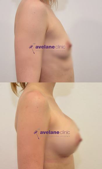 Výsledok estetickej operácie