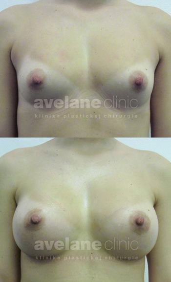 Výsledky operácie na Avelane clinic