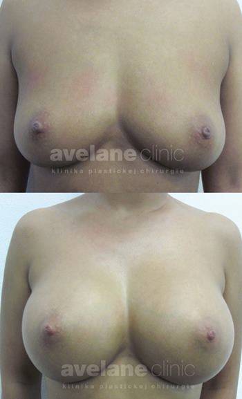 Po úprave pŕs s implantátmi