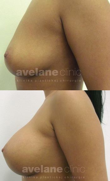 Po úprave pŕs s implantátmi – výsledok