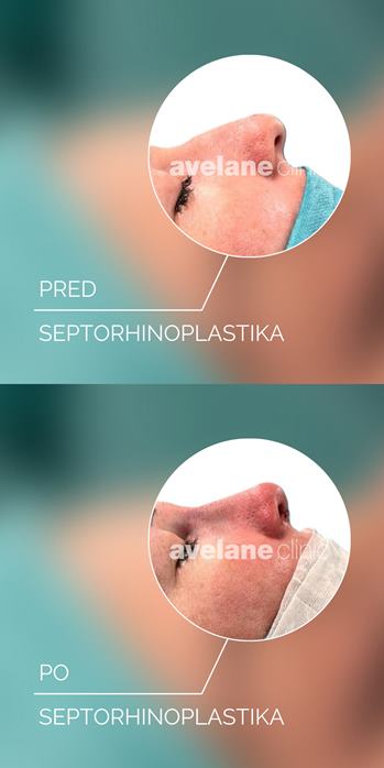 Septorhinoplastika
