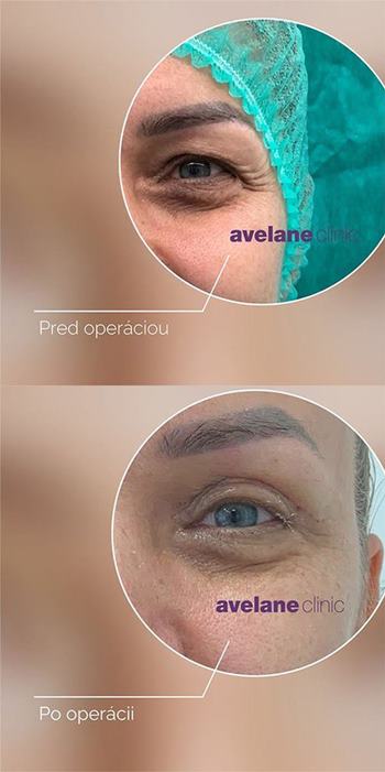 Plastická operácia viečok