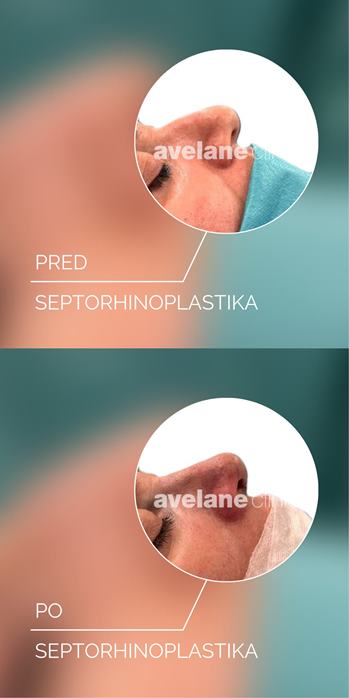Septorhinoplastika