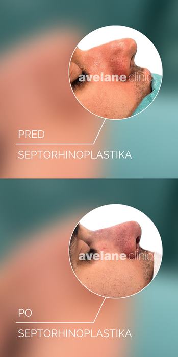 Septorhinoplastika