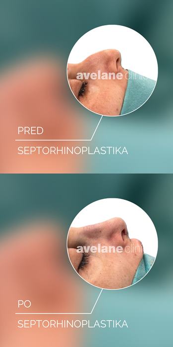 Septorhinoplastika