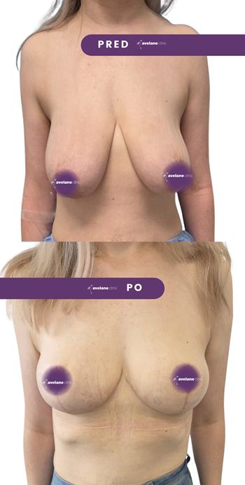 Modelácia prsníkov bez implantátov.